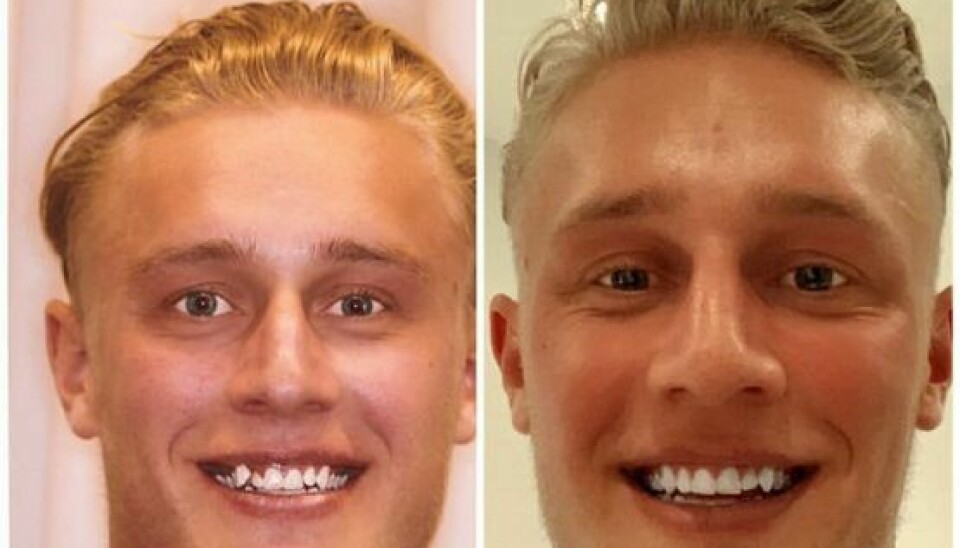 Her ses Olivers tænder før og efter tandreguleringen. (Foto: Privat)