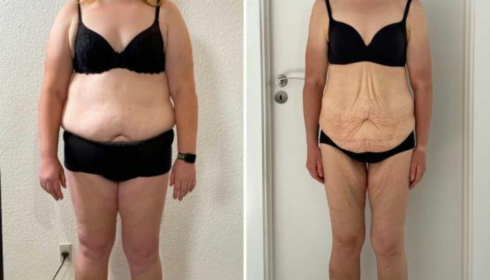 Isabel vejede 96 kilo og endte ud med 69 kilo. Forinden havde hun tabt 55 kilo af en vægt på daværende tidspunkt på 151 kilo. Hun har fået godkendt en operation til opstramning af maveskindet. (Foto: Michelle Kristensen)