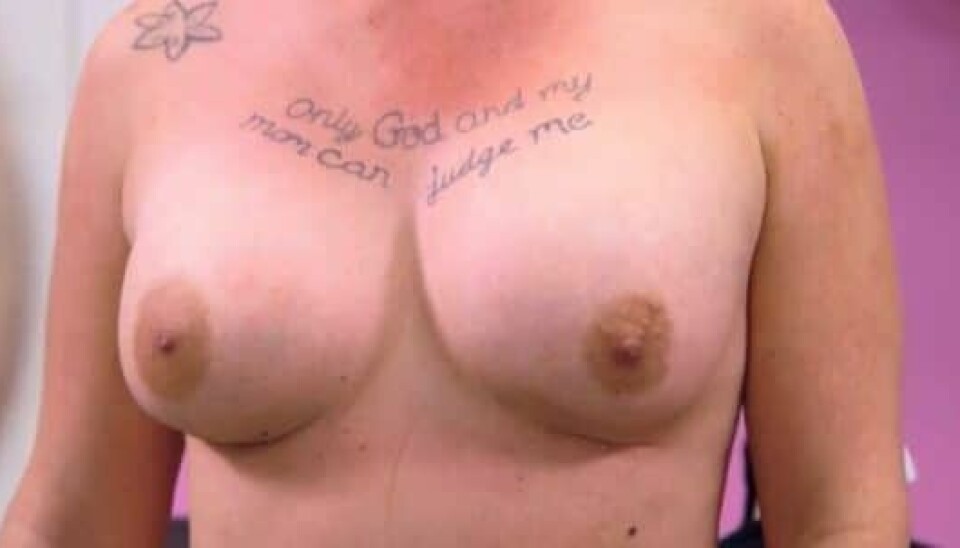Således så Sofies bryster ud i 'Mit plastikmareridt', hvor hun viser dem frem efter hendes fejloperation (Foto: Viaplay)