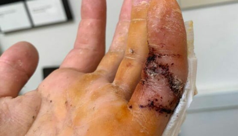 Således så Daniels finger ud, da han fik gipsen af efter tre uger (Foto: Privat)