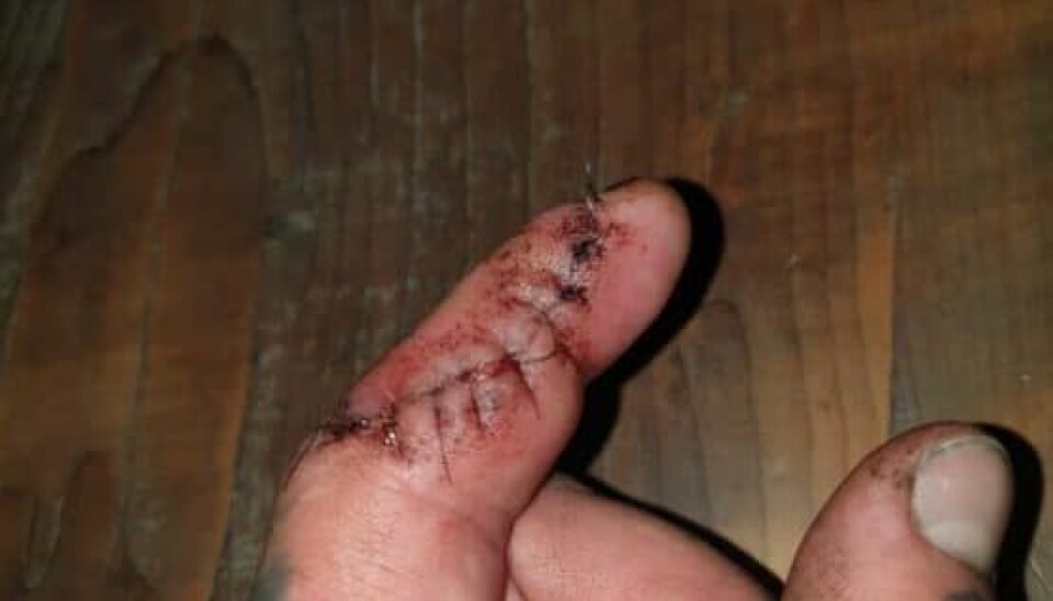 Simons finger med 9 sting. (Foto: Privat)