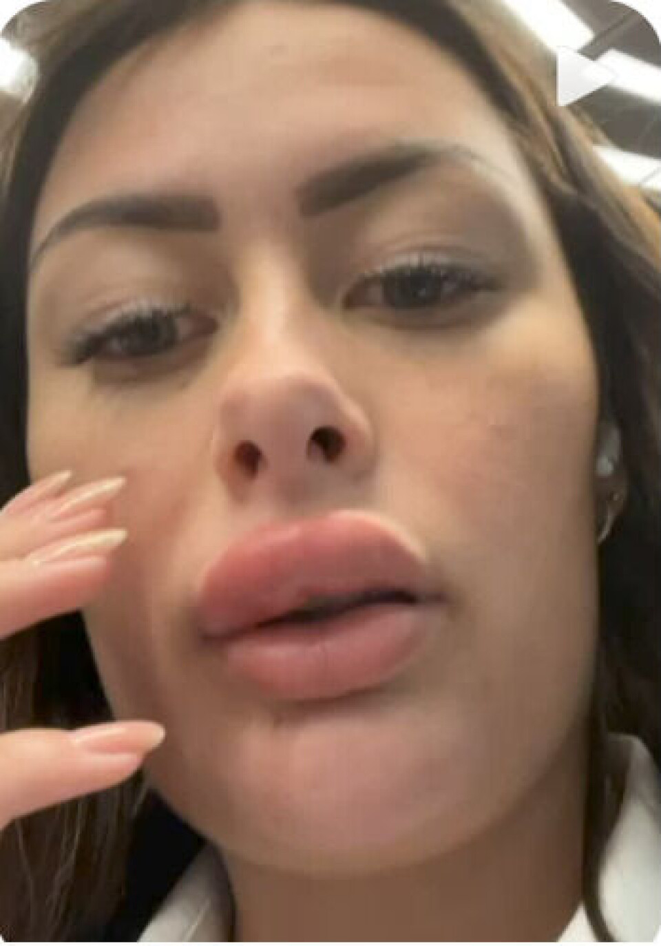 Amanda Mogensens læbe er tydeligt hævet. -'Duckface ligner Anders And', skriver hun i sin story. (Foto: privat) Amanda Mogensens læbe er tydeligt hævet. -'Duckface ligner Anders And', skriver hun i sin story. (Foto: privat)
