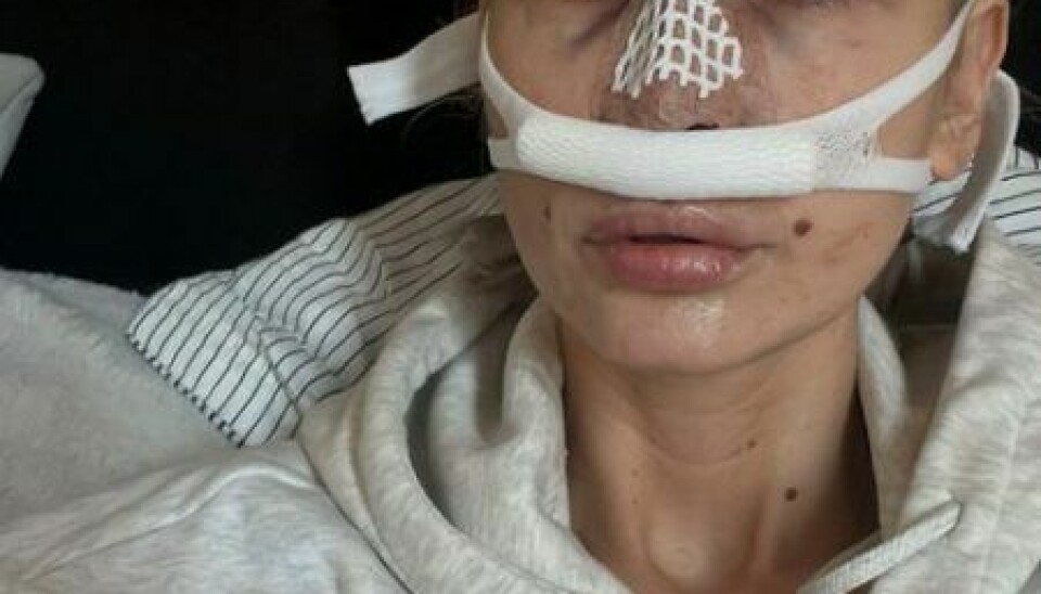 Camilla Nederby efter næseoperation (Foto: Privat)